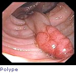 polype